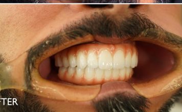 أطباء “ميدكير دينتوفاسيس” يُعيدون ترميم فك مريض إماراتي بعد تعرضه لحادث مروري خطير